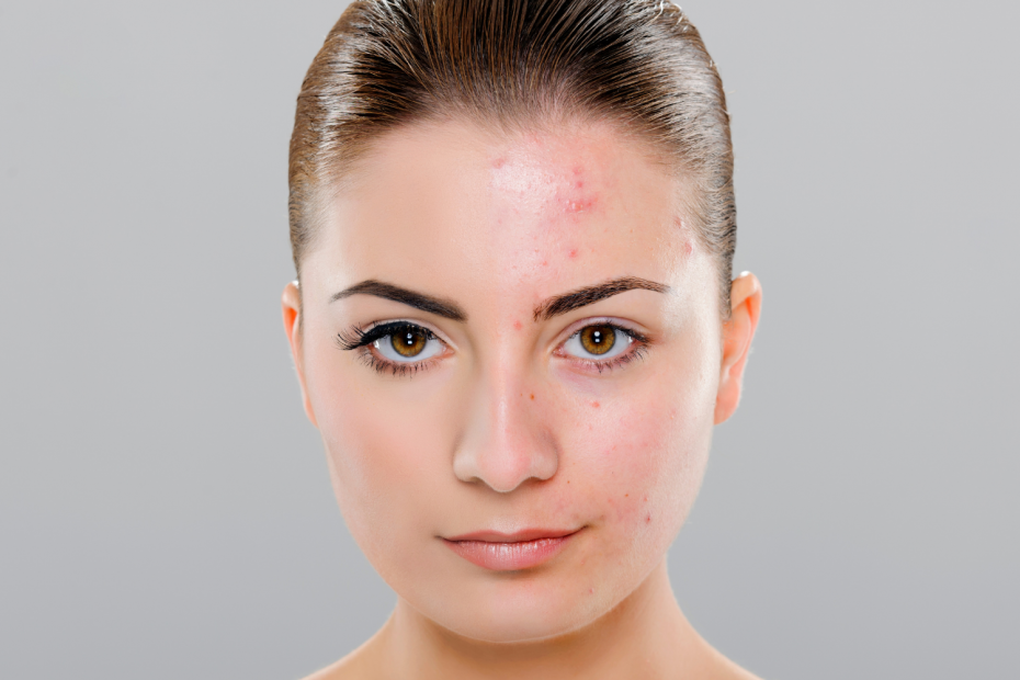 Mujer antes y después de haber combatido el acné con nuestros consejos